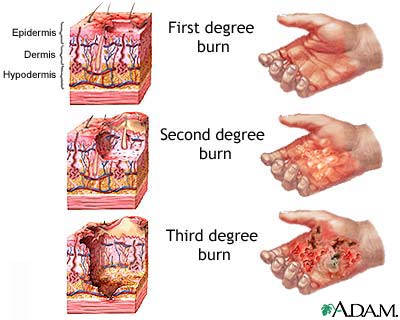 First Burn